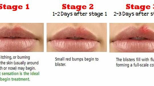 dating for genital herpes